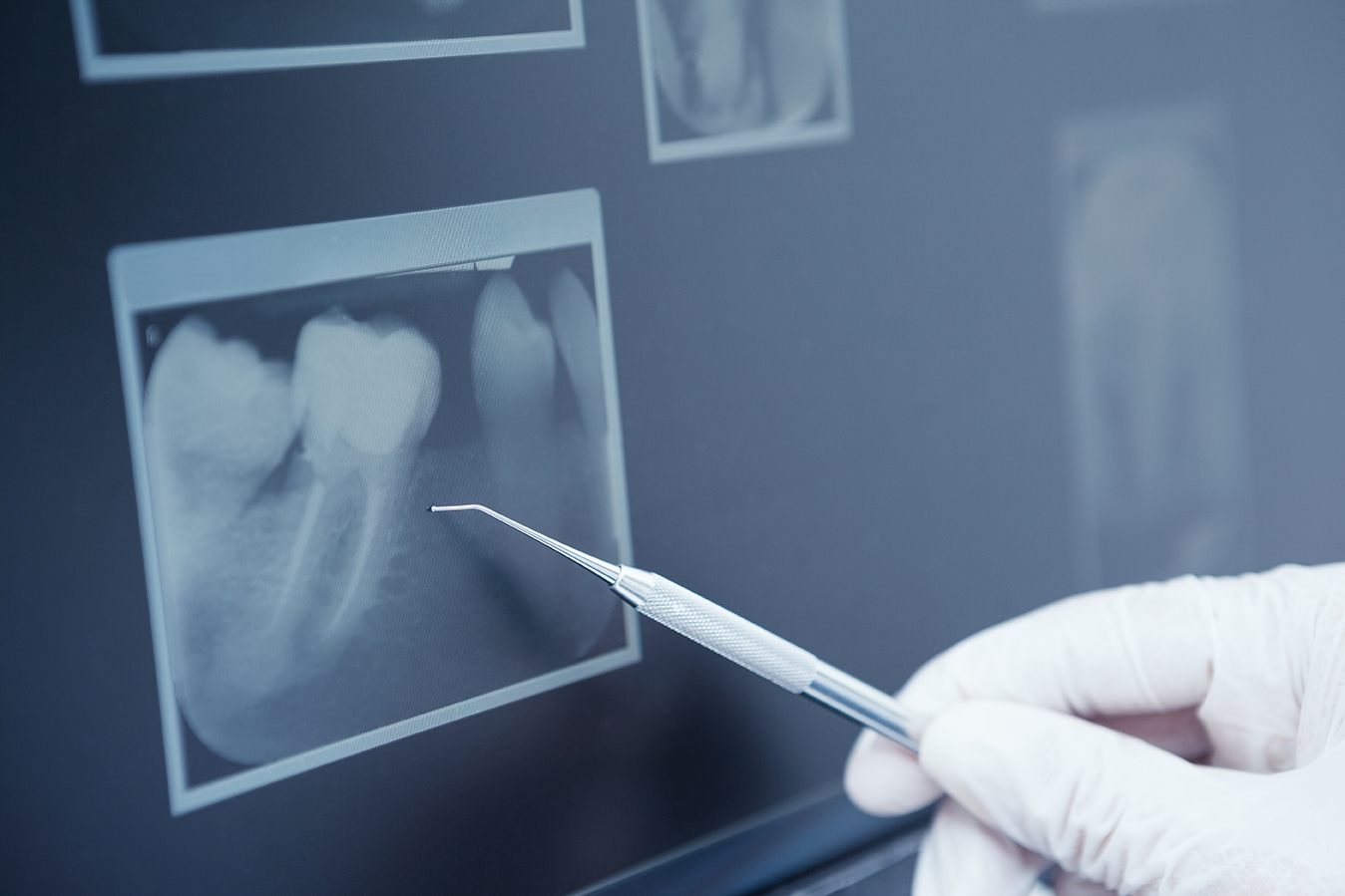 radiografia dental